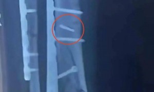 两人同病房同一天手术，体内都遗落手术钻头，医院和患者达成和解，相关医师此前已被行政处罚